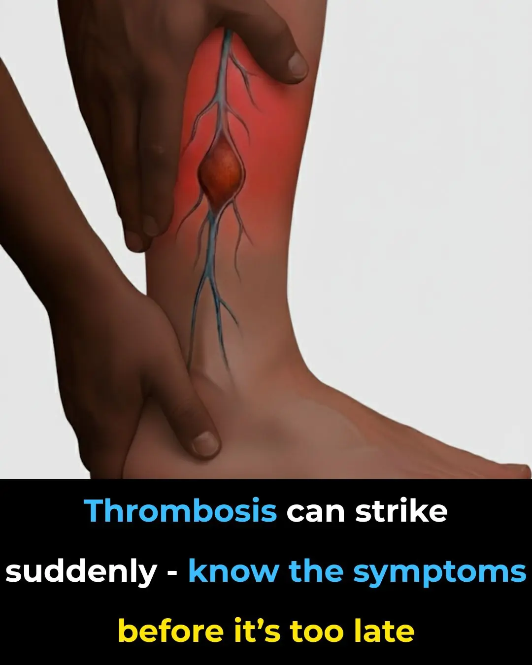 Blood Clot in Leg: Signs and Symptoms You Shouldn’t Ignore (Pictures Included)
