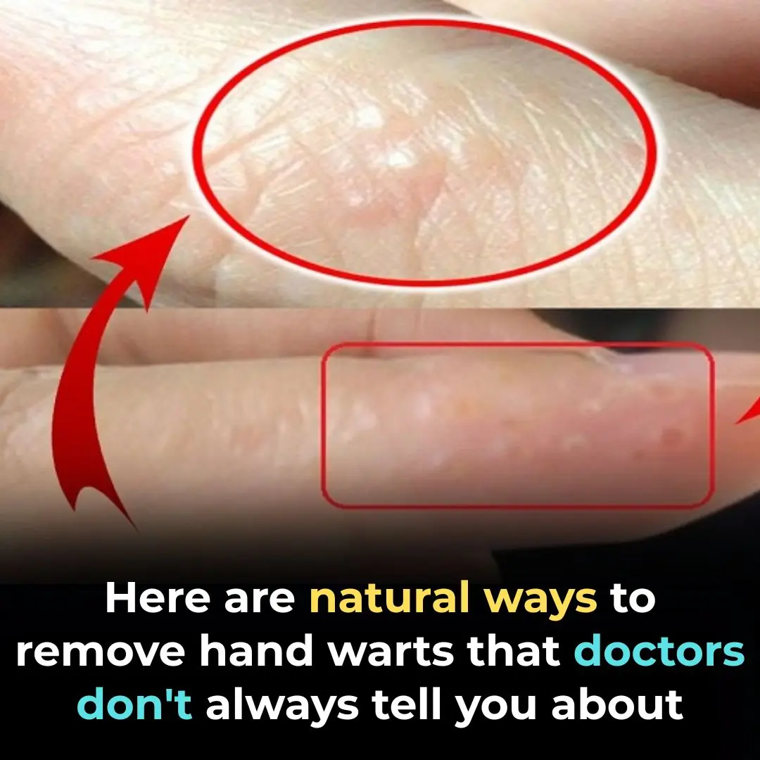 Warts on Hands: Causes and Effective Natural Treatments