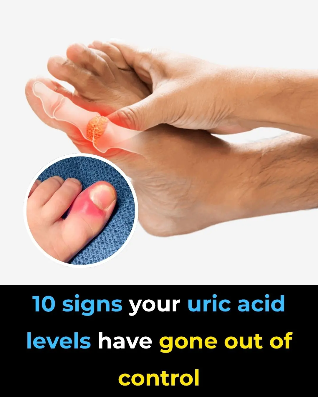 Reducing Acid Sign 10 Signs Your Uric Acid Levels Have Gone Out of Control