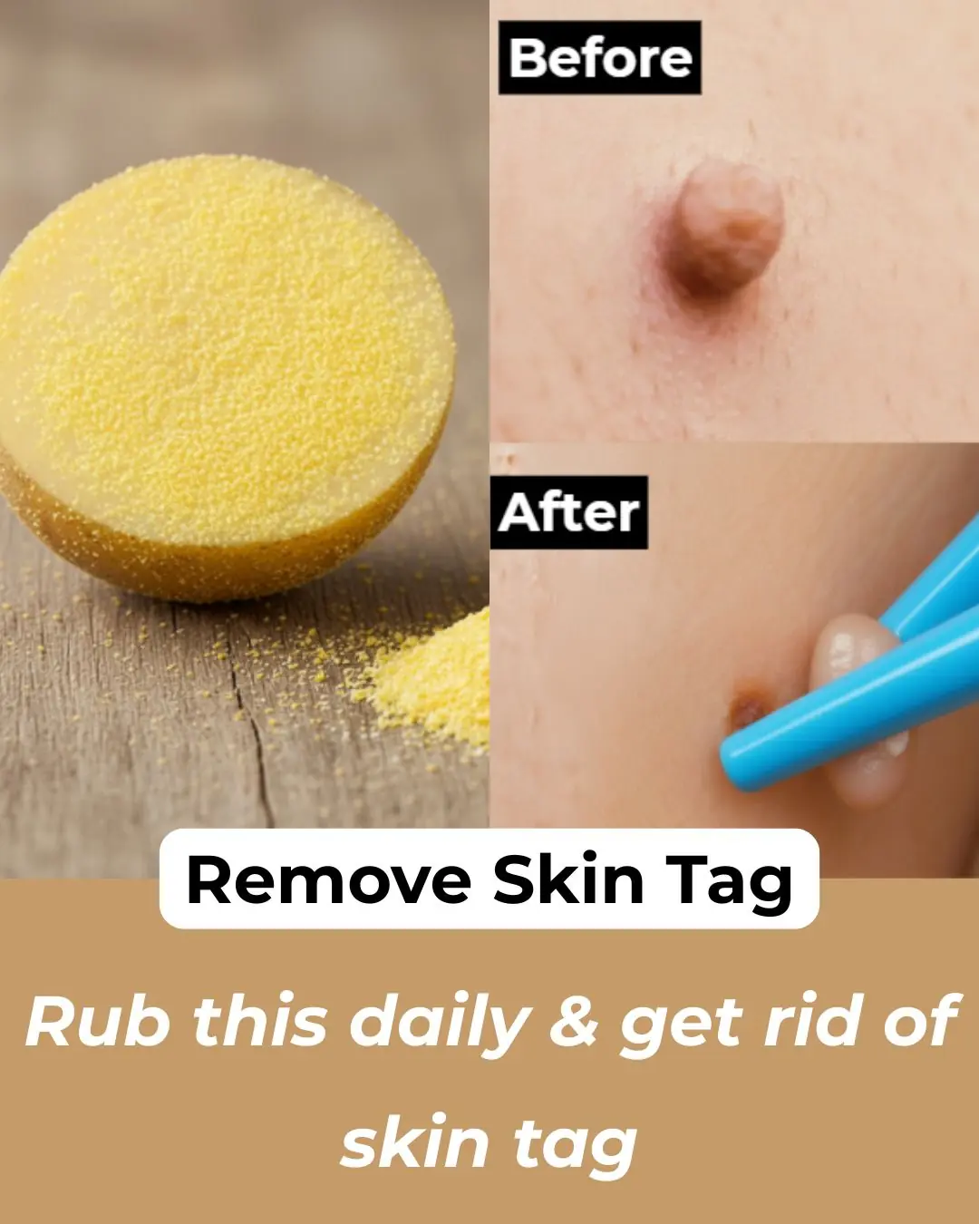 3 Home Remedies to get rid of Skin Tags – Skin Tag Removal