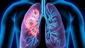 7 Early Signs and Symptoms of Lung Cancer You Should Never Ignore