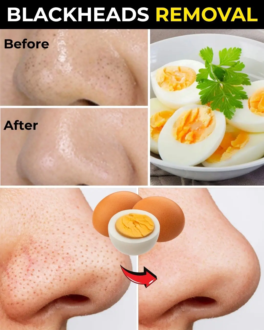 Say Goodbye to Blackheads with Just One Egg