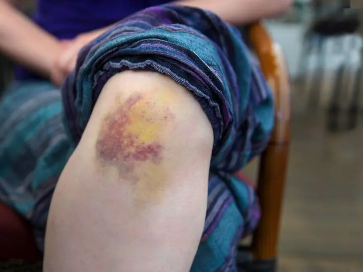 If Bruises Keep Showing Up Out Of Nowhere This Is What It Means for Your Health