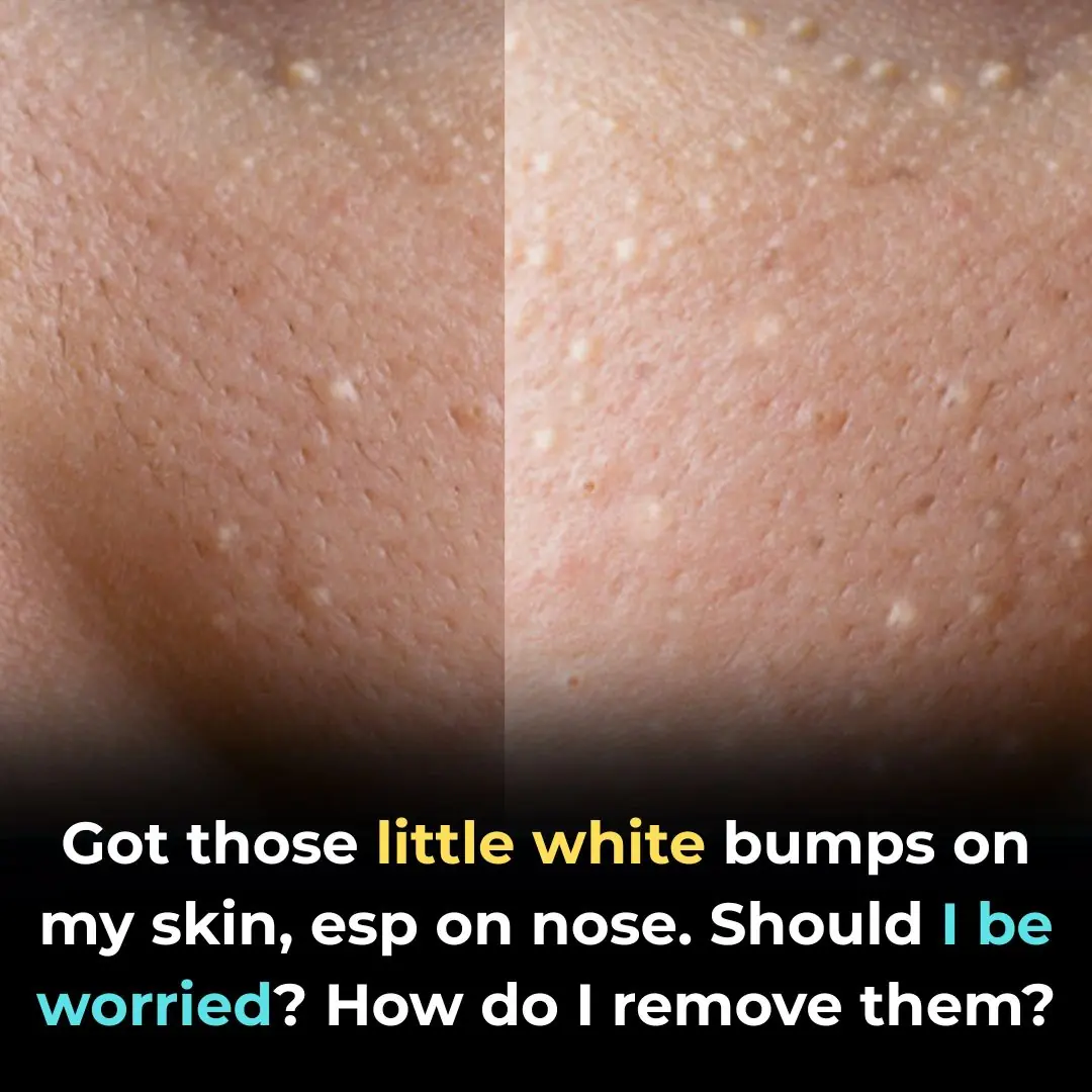 White Bumps on Your Face Don’t Try to Remove Them