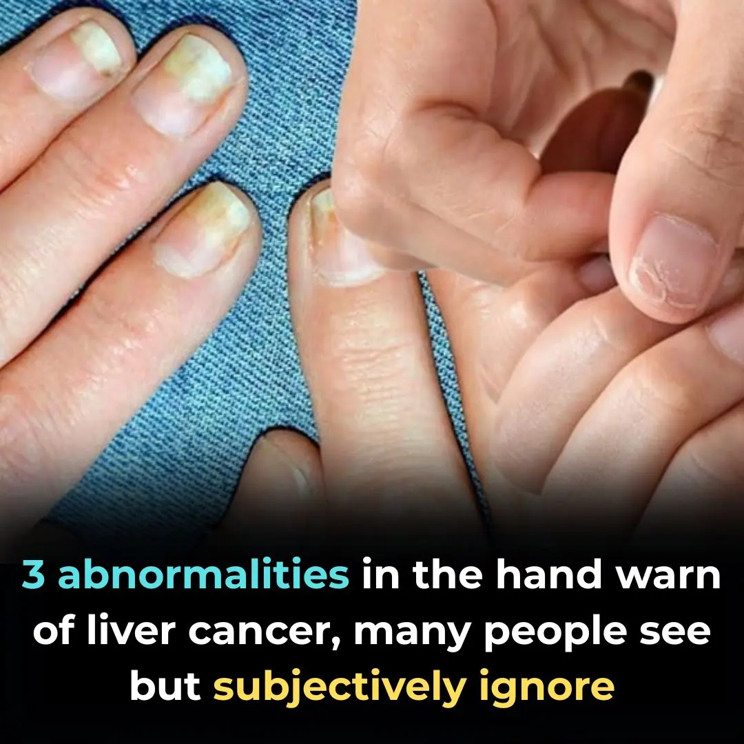 3 abnormalities in the hand warn of liver cancer, many people see but subjectively ignore