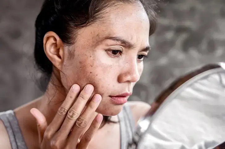 How to Remove Age Spots Naturally with Lemon Juice