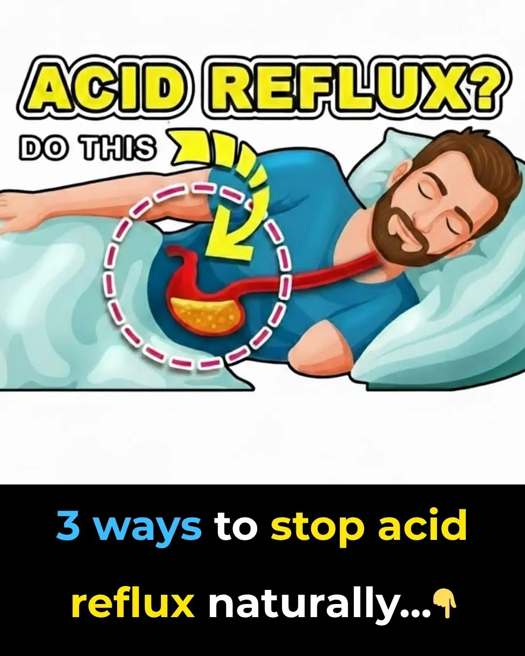 3 Ways to Stop Acid Reflux Naturally