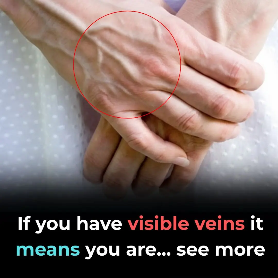 When to Worry About Veins That Appear Out of Nowhere
