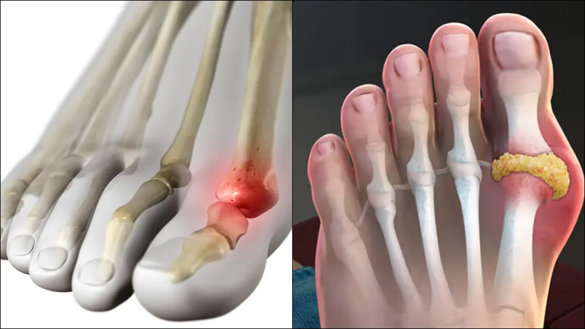 HOW TO QUICKLY REMOVE URIC ACID CRYSTALLIZATION FROM YOUR BODY TO PREVENT GOUT AND JOINT PAIN