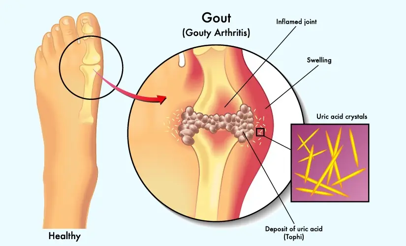 THE NATURAL SECRET DOCTORS NEVER TELL YOU THAT MELTS AWAY URIC ACID