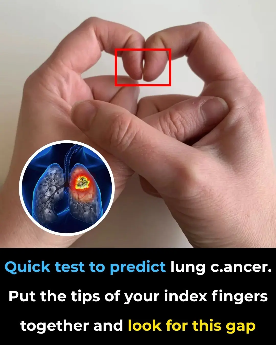 Schamroth Window Test May Reveal if You Have Finger Clubbing