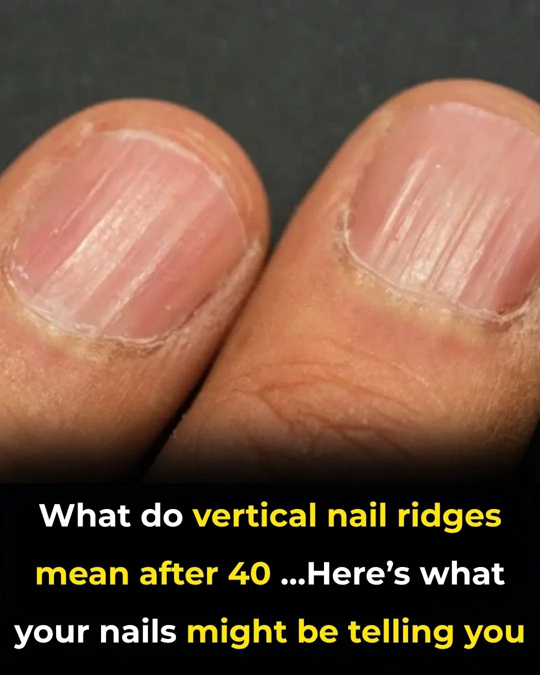 What Do Vertical Nail Ridges Mean After 40