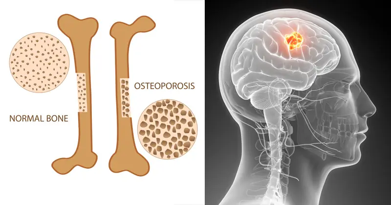 This Drink Destroys Your Bones From the Inside and Harms Every Organ on Its Way Out