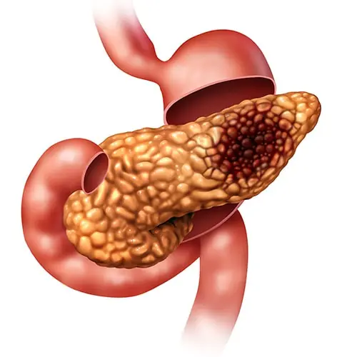 5 Early Warning Signs of Pancreatic Cancer, According to Survivors