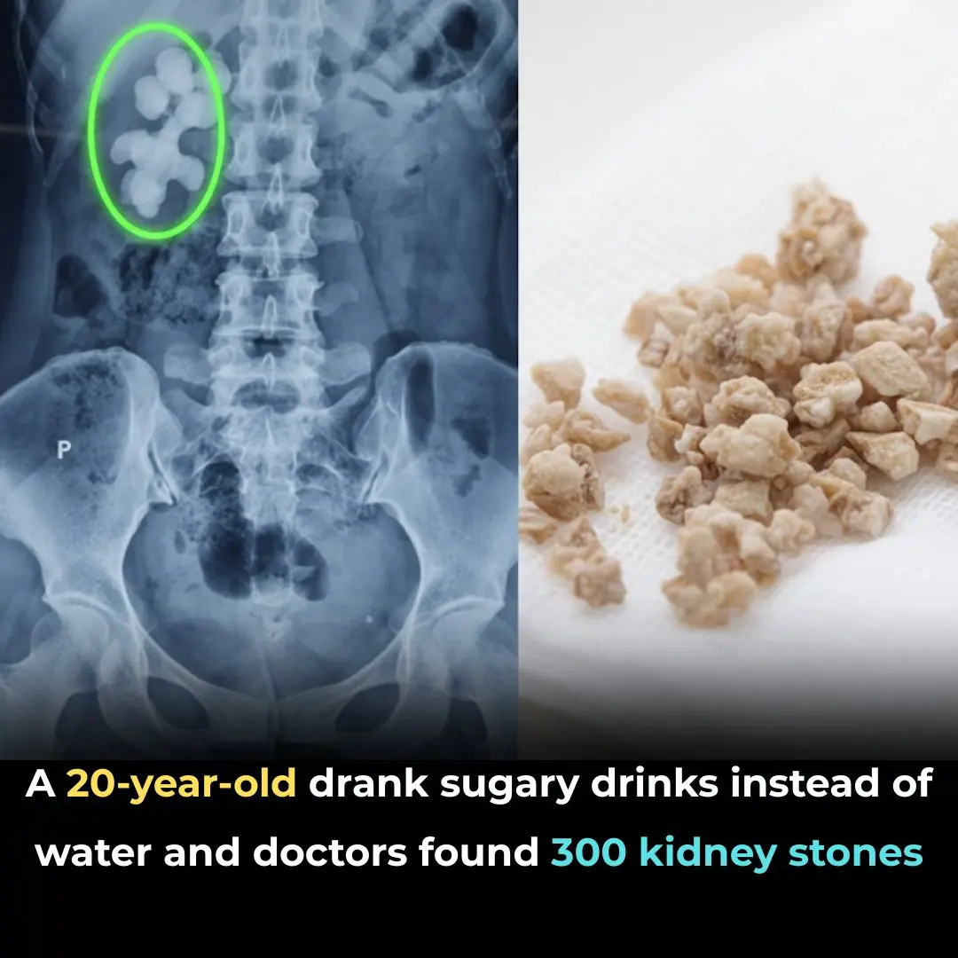 Woman in Taiwan Found With 300 Kidney Stones After Years of Drinking Bubble Tea