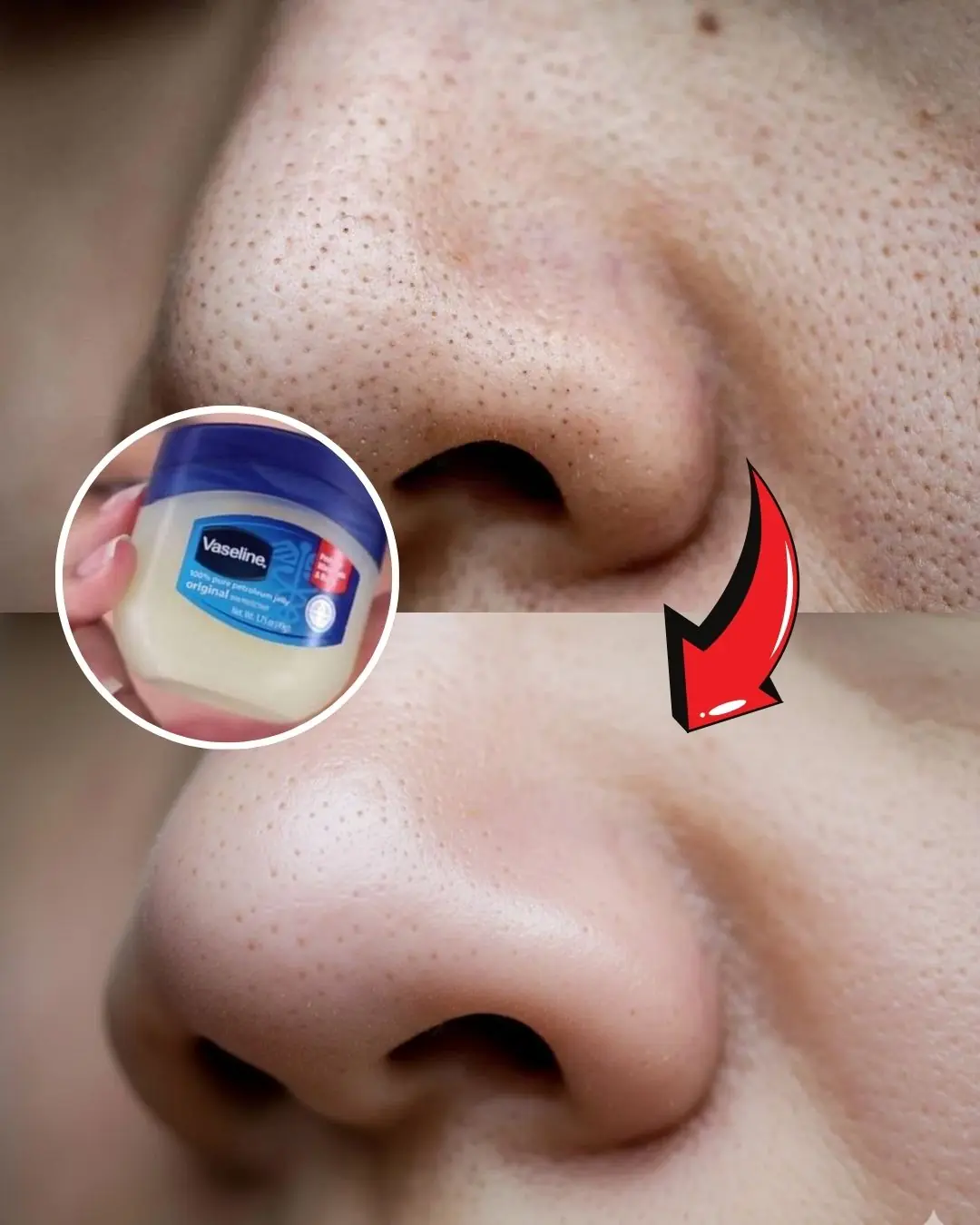 Remove Blackheads On Your Nose With Just a Mixture of Vaseline and This Cheap, Easy-to-find Ingredient
