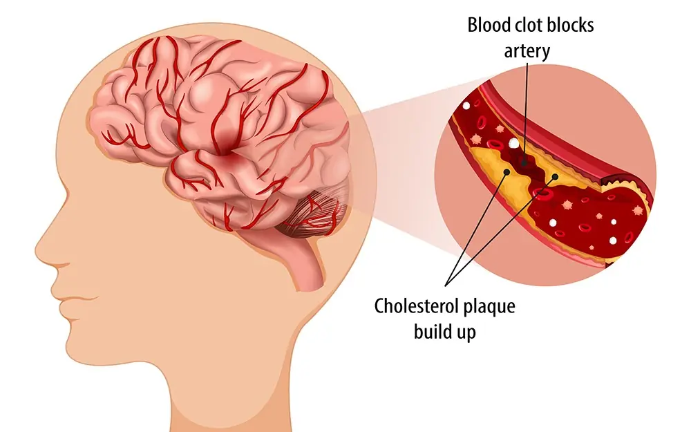 CLOGGED ARTERIES CAN CAUSE STROKES EAT THIS TO PROTECT YOUR BRAIN