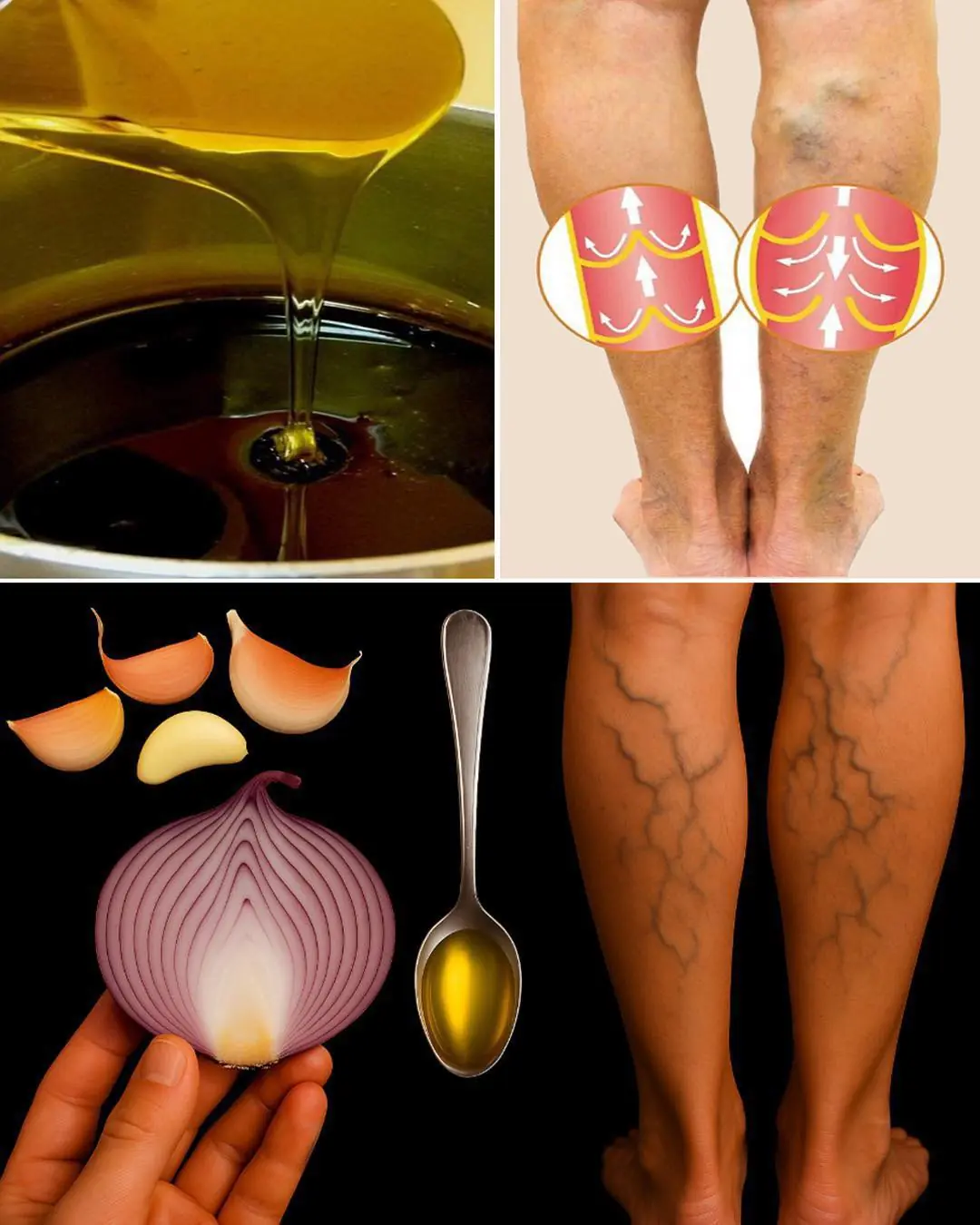 Onion, Garlic, and Olive Oil Remedy for Varicose Veins: Natural Treatment and Benefits