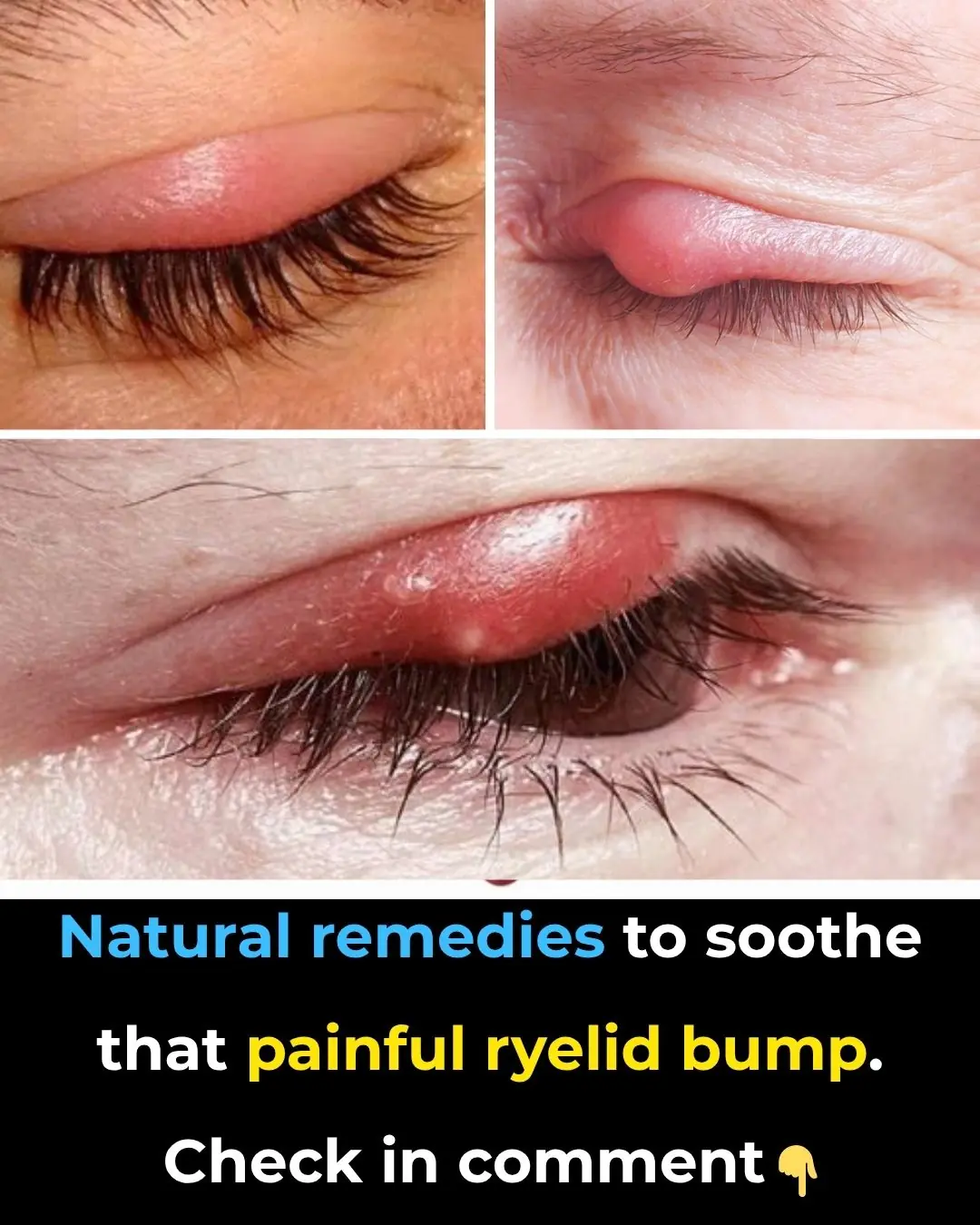Say Goodbye to Styes