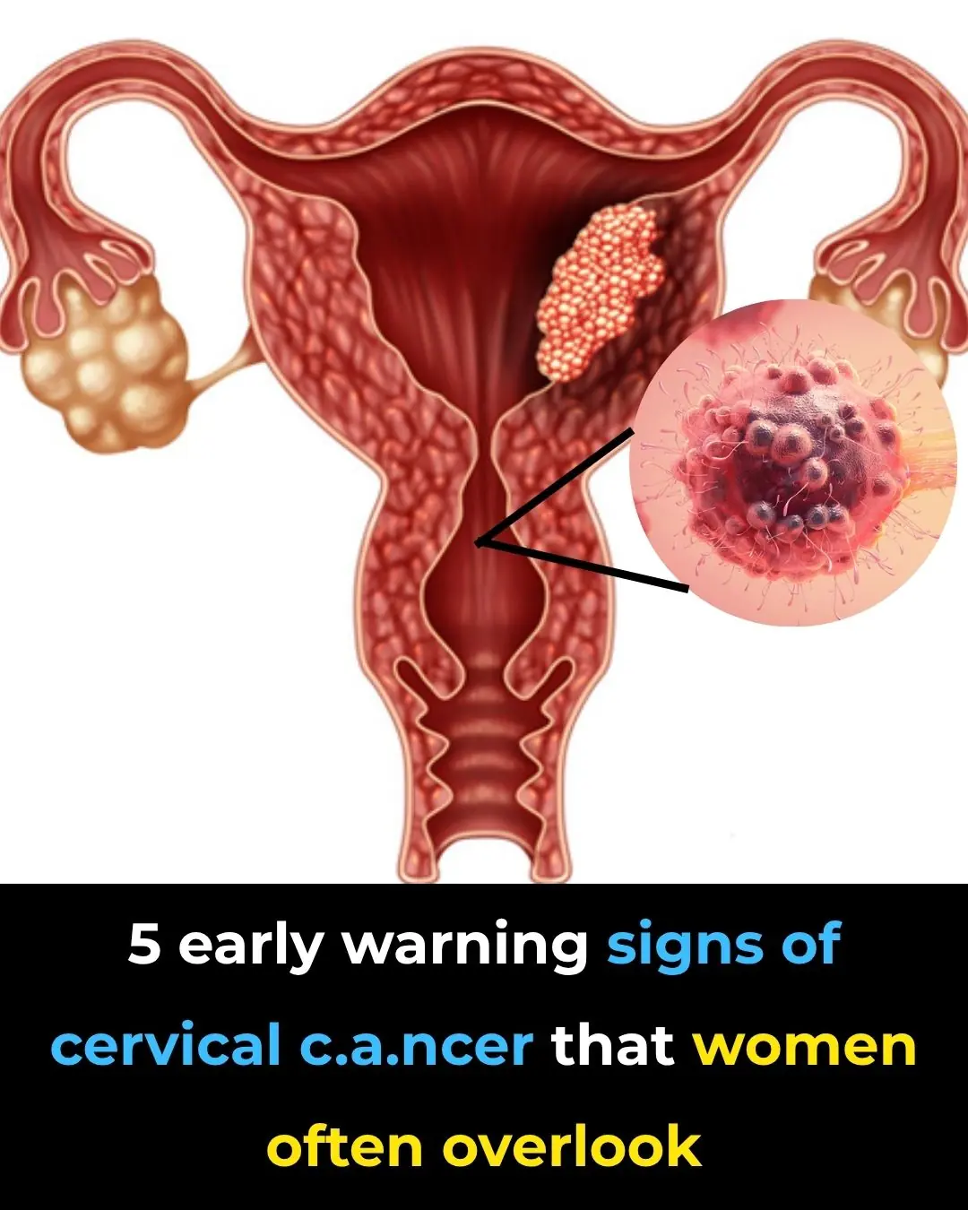 5 early warning signs of cervical cancer