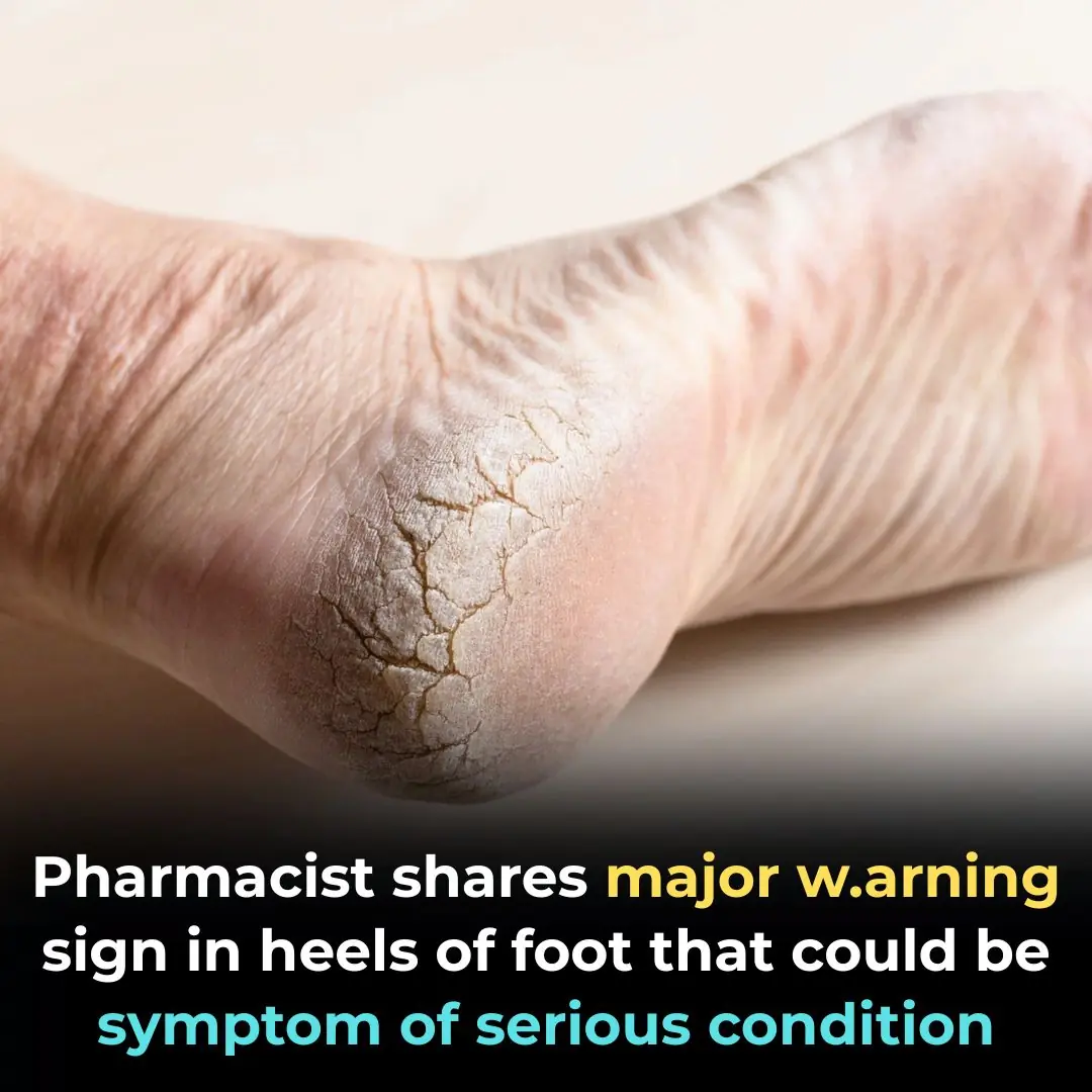 Cracked Heels Could Be a Warning Sign