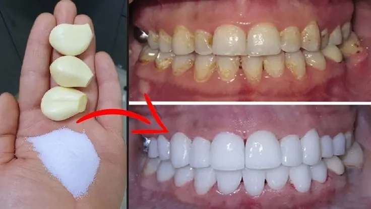 Secret that Dentists don't want you to know: Remove Tartar and Teeth Whitening in just 2 minutes
