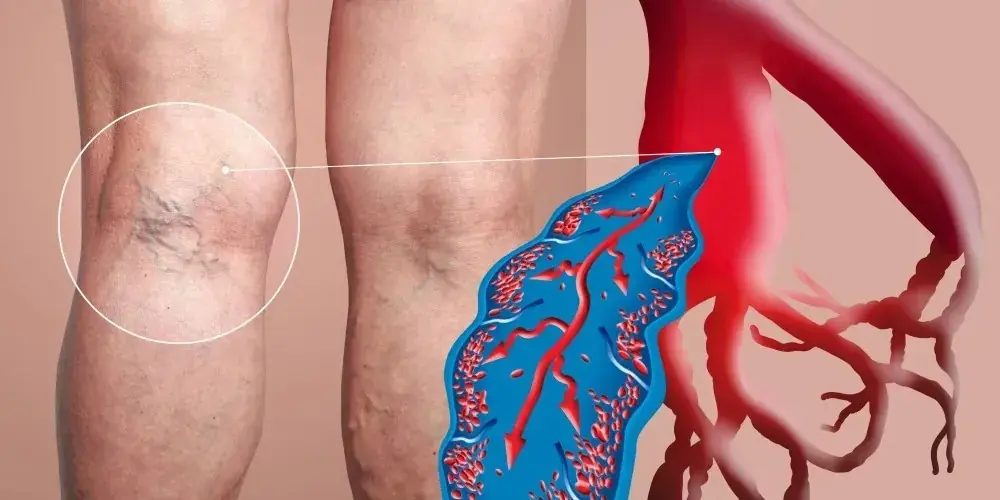 Thrombosis can strike suddenly — know the symptoms before it's too late