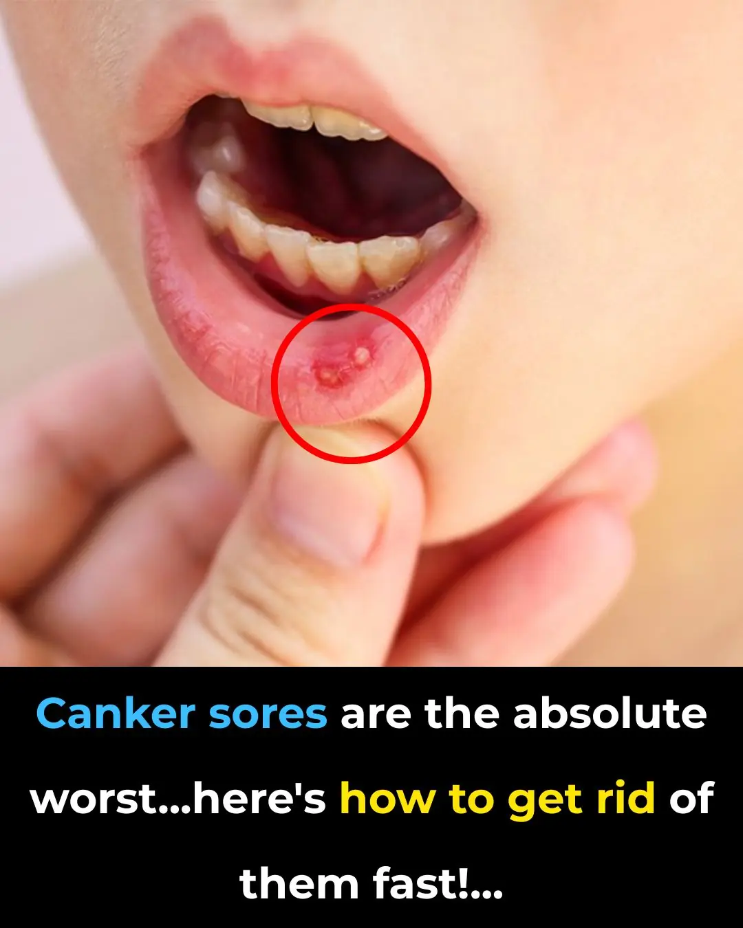 Canker Sores Are The Absolute WORST…Here’s How To Get Rid of Them Fast!