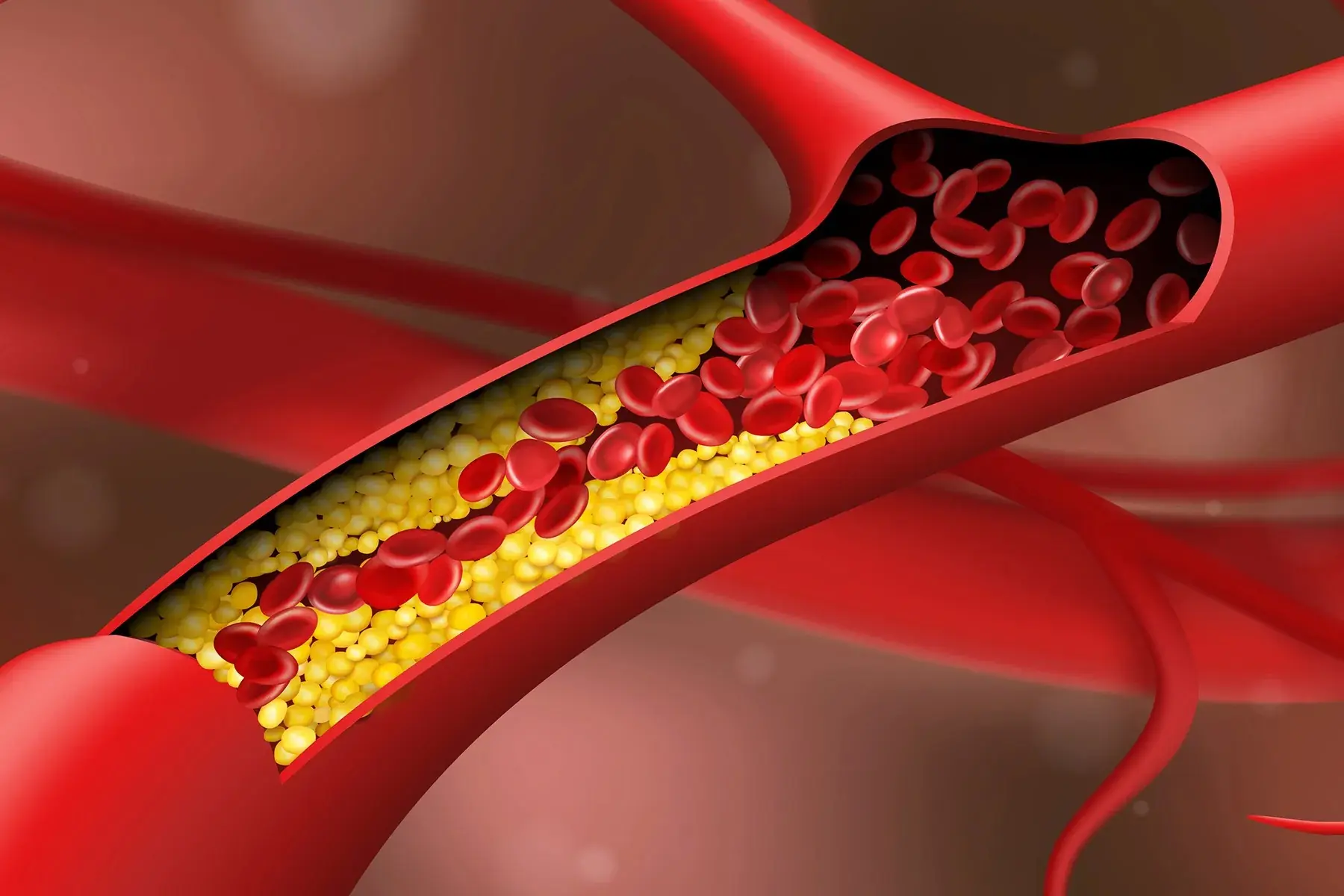 CLOGGED ARTERIES TRIGGER HEART ATTACKS AND STROKE EAT THIS TO HELP UNCLOG YOUR ARTERIES