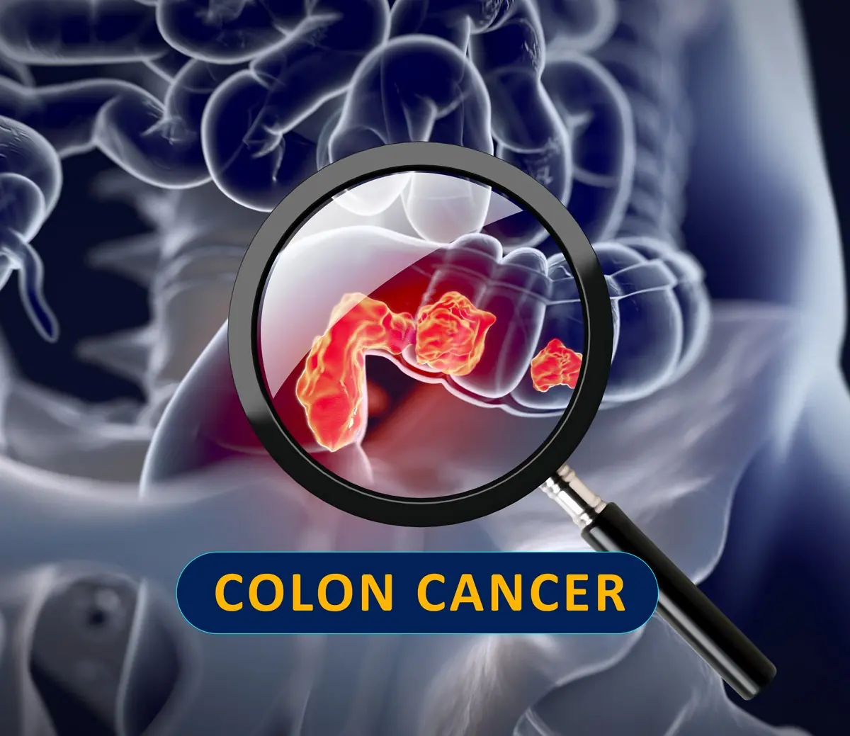 New Research Finds 40–50% of Colon Cancer Cases Can Be Prevented by Doing These Simple Things