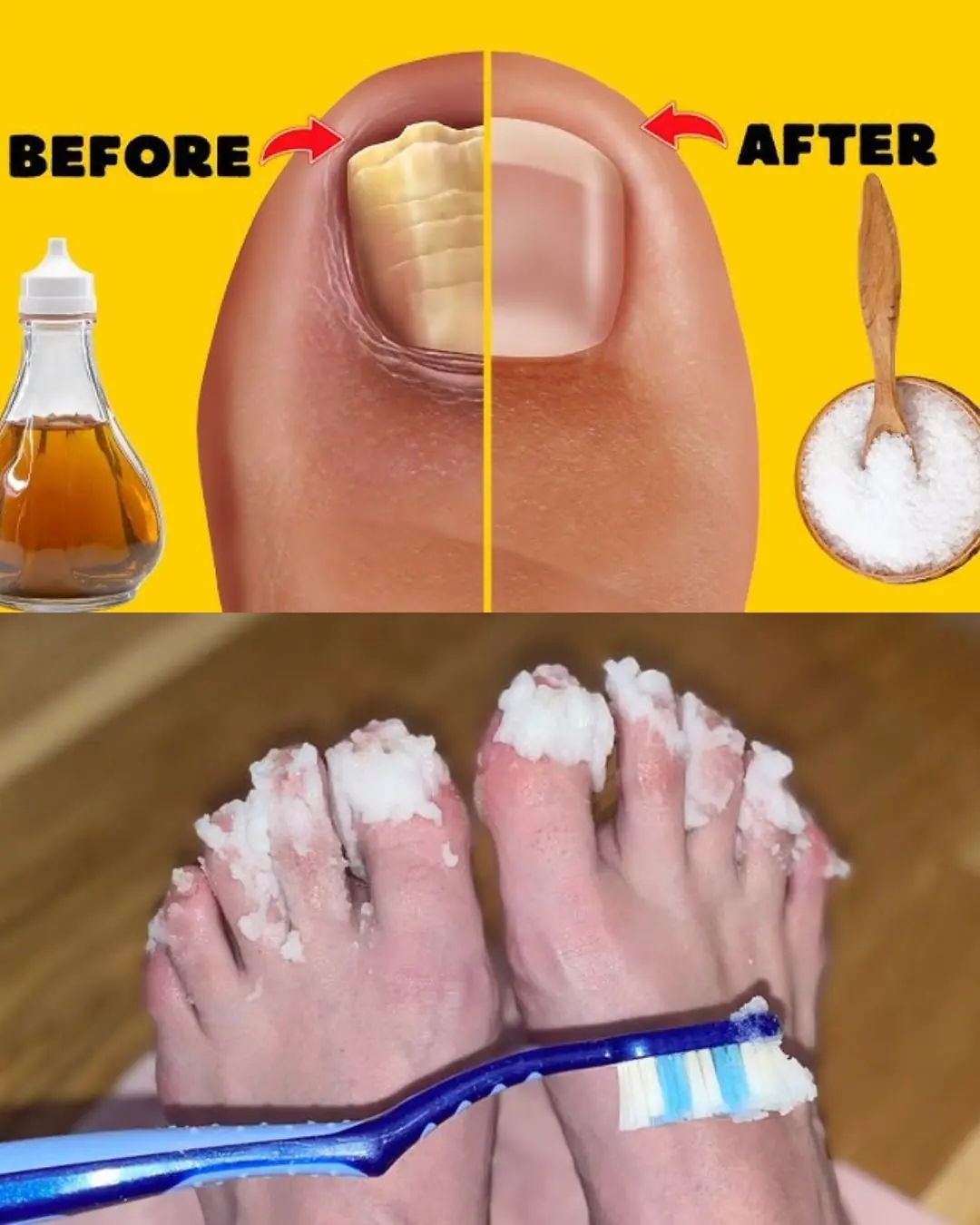 If you have nail fungus, try this natural cure; it goes away fast