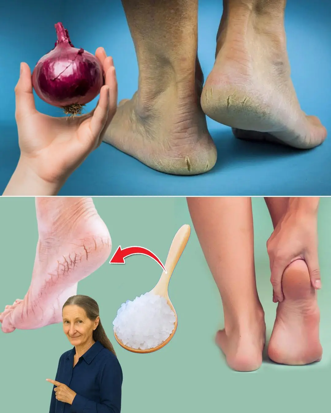 5 Natural Remedies for Cracked Heels: Red Onion, Sea Salt & More