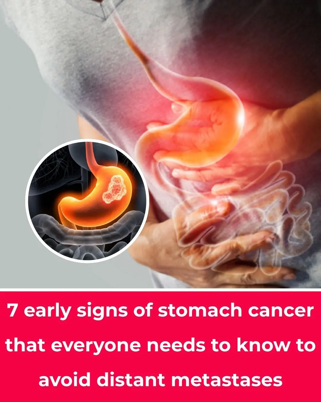 7 Early Signs of Stomach Cancer Everyone Should Know to Prevent Distant Metastasis