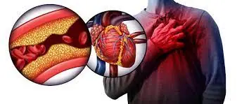 6 Warning Signs of a Clogged Artery Most People Ignore (Cardiologist Alert)