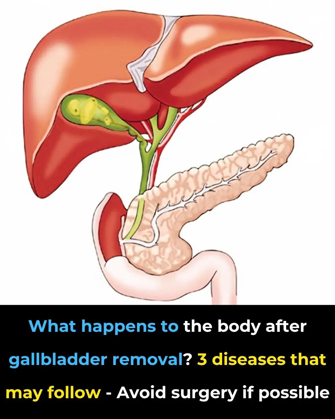 Side Effects and Dietary Recommendations Post Gallbladder Surgery