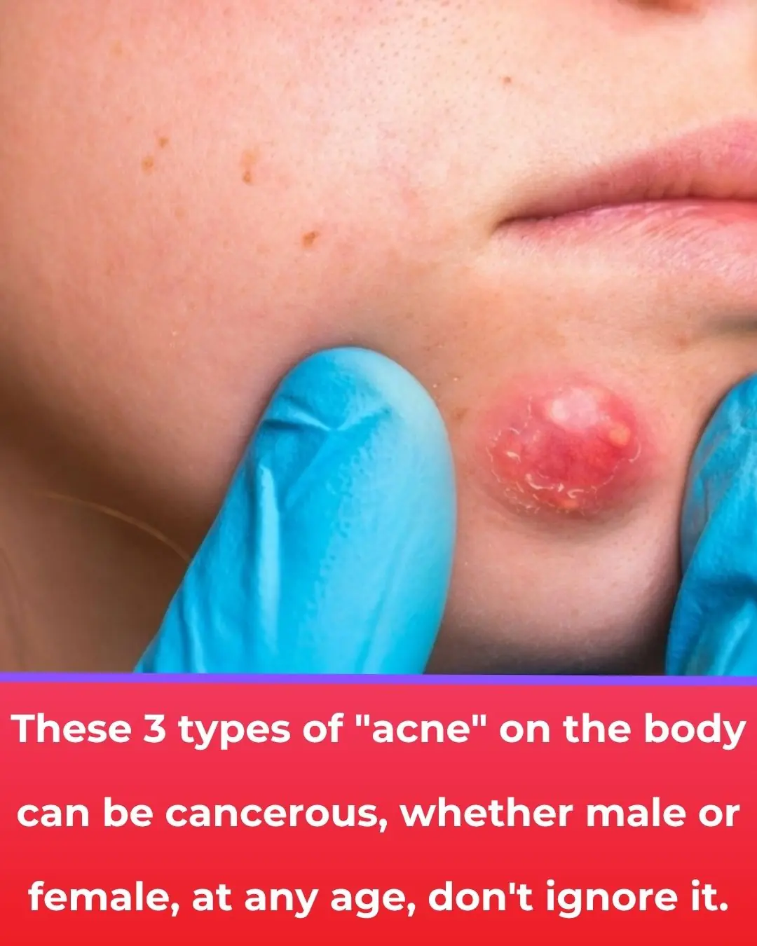 These 3 Types of "Lumps" on Your Body Could Be Cancer – Don't Ignore Them at Any Age, Regardless of Gender