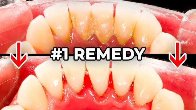 The #1 Most Effective Remedy for Dental Plaque (And How to Beat Tartar at Home)