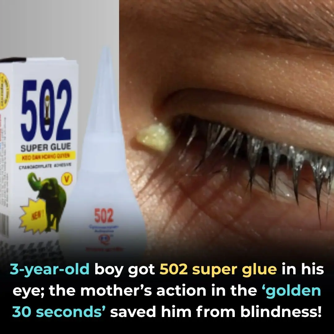 A 3-Year-Old Boy Got Super Glue in His Eye — His Mother’s “Golden 30 Seconds” Saved His Sight