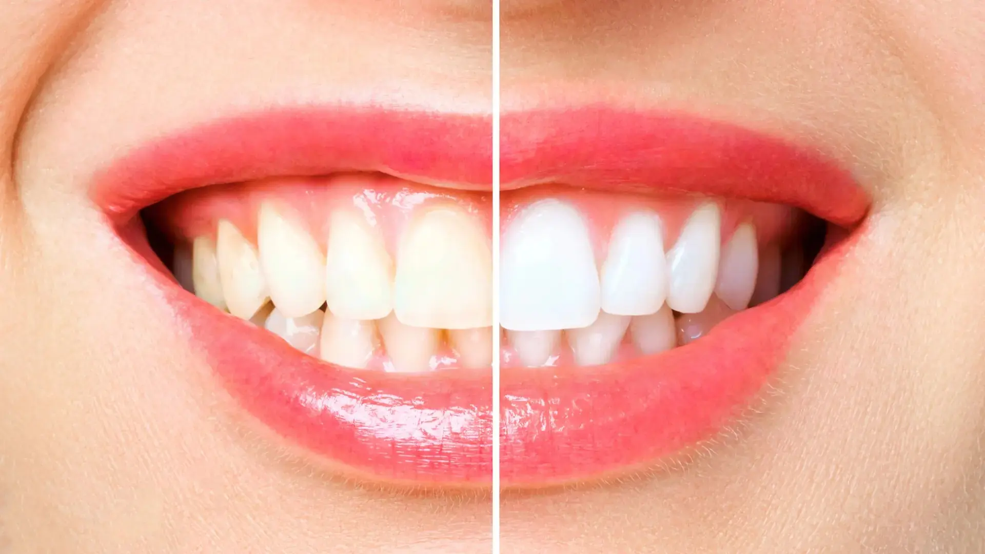 DENTISTS HATE HOW SIMPLE THIS TEETH WHITENING HACK IS
