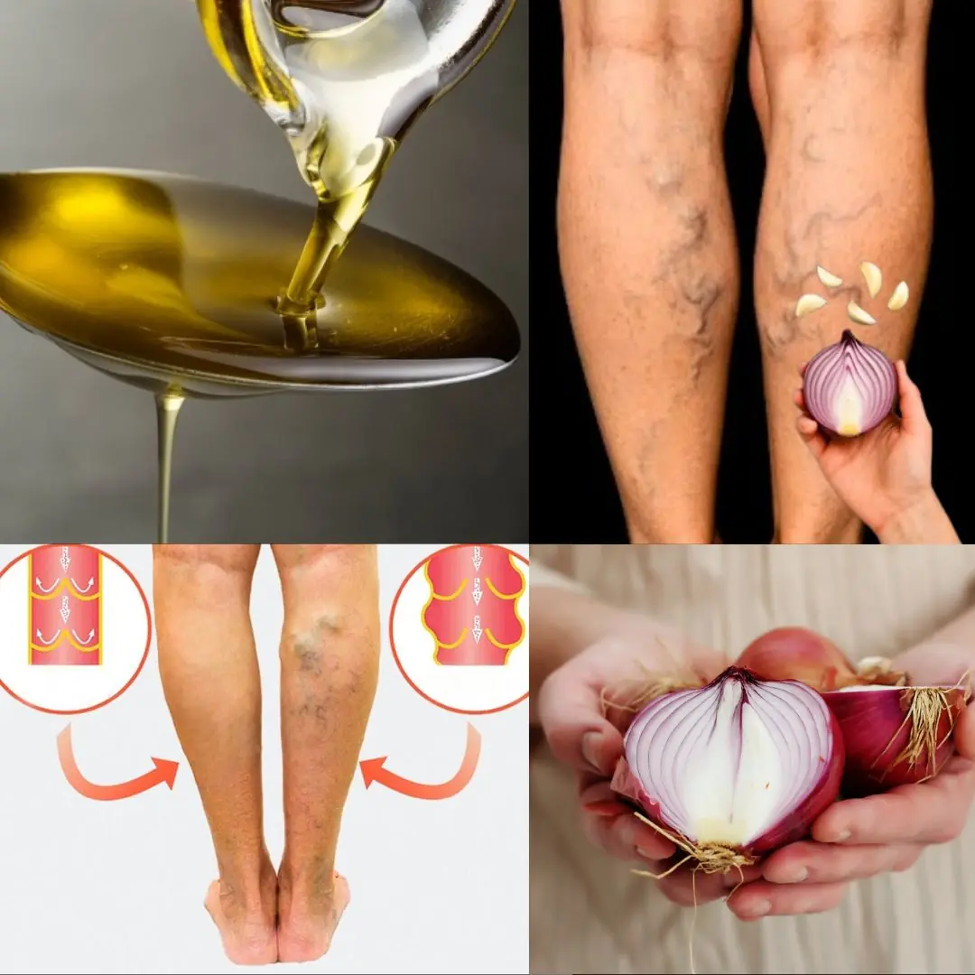 Onion, Garlic, and Olive Oil Remedy for Varicose Veins: Natural Treatment and Benefits