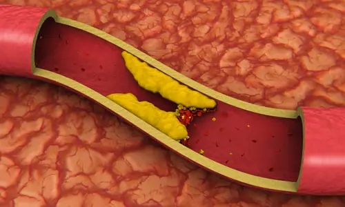 Warning Signs Your Arteries Need Cleansing and The Foods That Do It Best