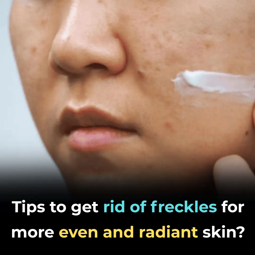 Smart Ways to Fade Freckles and Reveal a More Even, Radiant Skin Tone