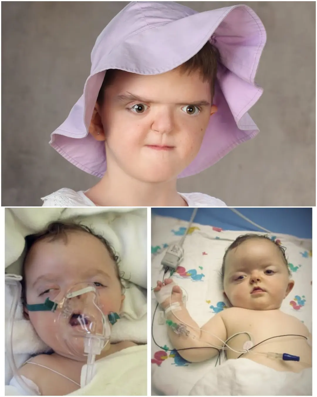 A Life on Borrowed Time: Karolinka’s Fight Against Apert Syndrome