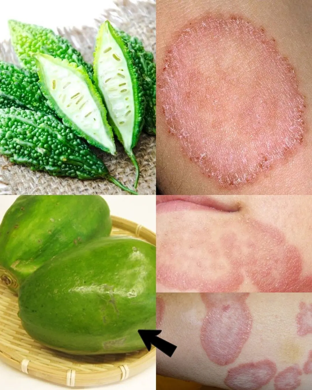 9 Powerful Home Remedies to Get Rid of Fungal Infection (Daad, Khaj, Khujli) Fast