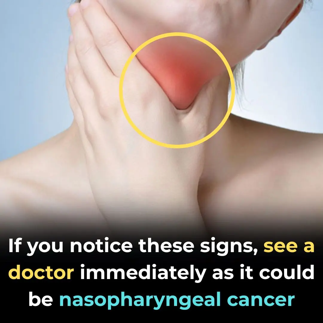 Warning Signs You Should Never Ignore: When These Symptoms Appear, See a Doctor Immediately — It Could Be Late-Stage Nasopharyngeal Cancer