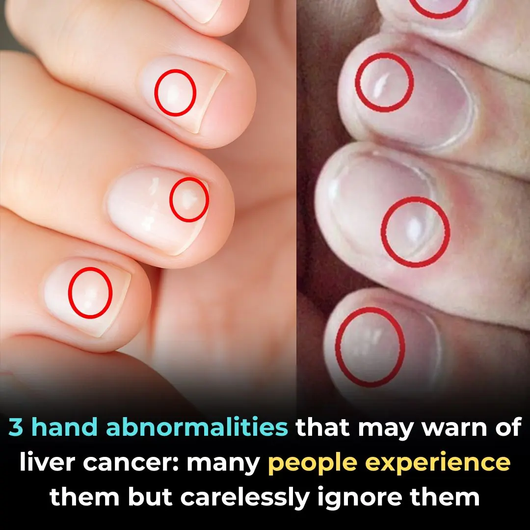 3 Unusual Signs on Your Hands That Could Signal Liver Cancer