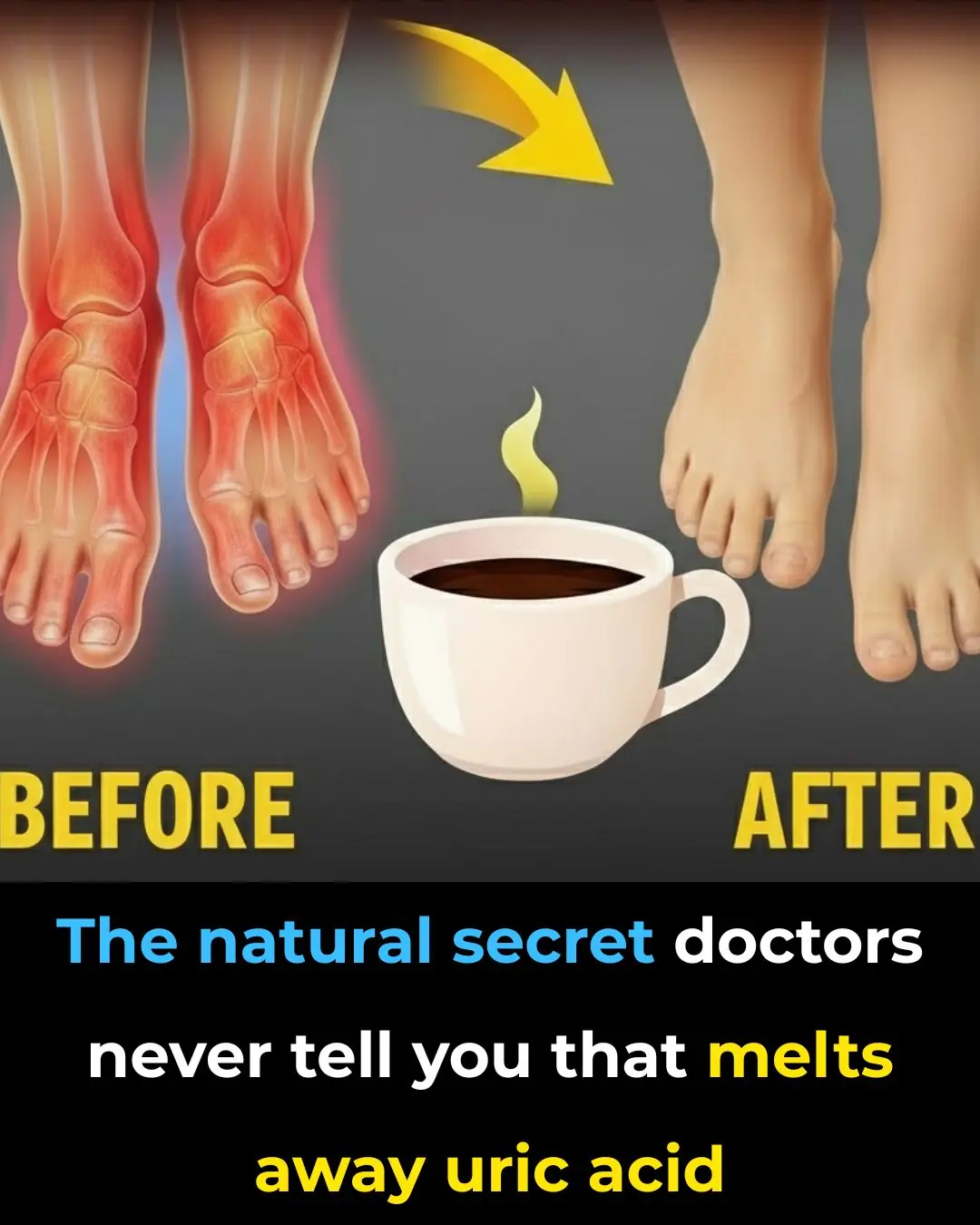The Best Natural Gout Treatments: Remove Uric Acid Crystallization To Prevent Gout And Joint Pain