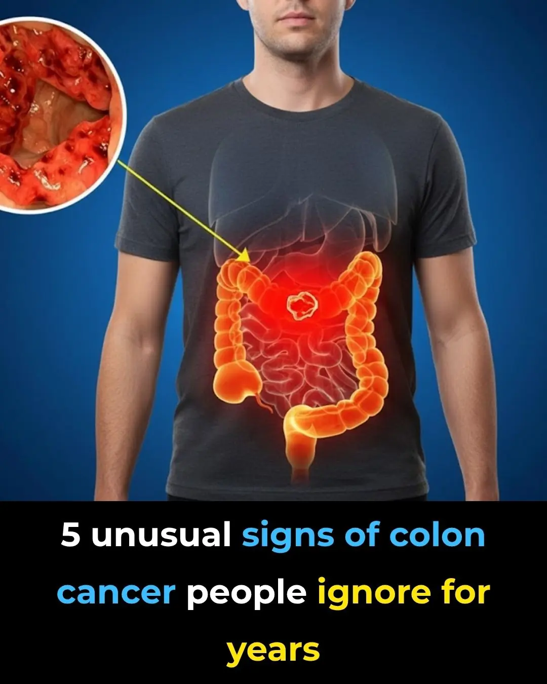 🚨 The Silent Danger: Early Signs and Prevention of Colorectal Cancer