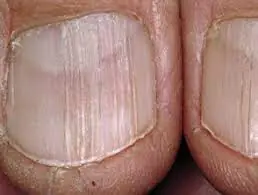 Vertical Nail Ridges? Here’s What Causes Them — and How to Fix It
