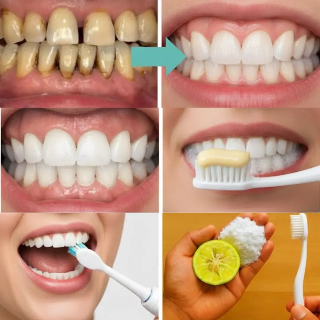 7 Natural Home Remedies to Whiten Your Teeth at Home